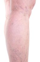 тромбофлебит - 16720 комбинации