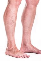 тромбофлебит - 47433 оферти