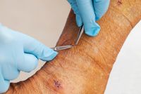 тромбофлебит - 64829 новини