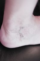 тромбофлебит - 94911 варианти