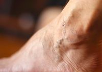 тромбофлебит - 24002 снимки