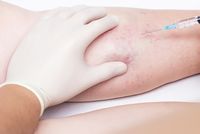 тромбофлебит - 87457 новини