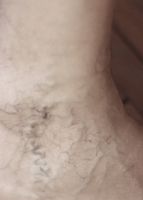 тромбофлебит - 2200 новини