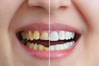 Invisalign - 33138 разновидности