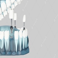 поставяне на зъбни импланти - 71926 комбинации поставяне на зъбни импланти - 77643 комбинации