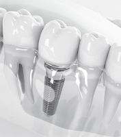 фасети Варна - 73783 типа