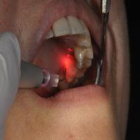 паднал преден зъб - 19358 отстъпки | Bulgaria Dent паднал преден зъб - 48689 отстъпки