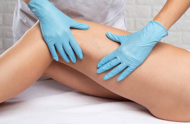 лечение на разширени вени - 35360 снимки | medicabilis.eu лечение на разширени вени - 65612 снимки